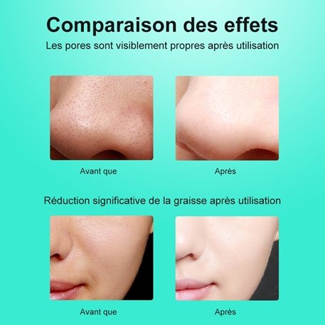 Appareil massage visage ultrasons dissolvant de points noirs